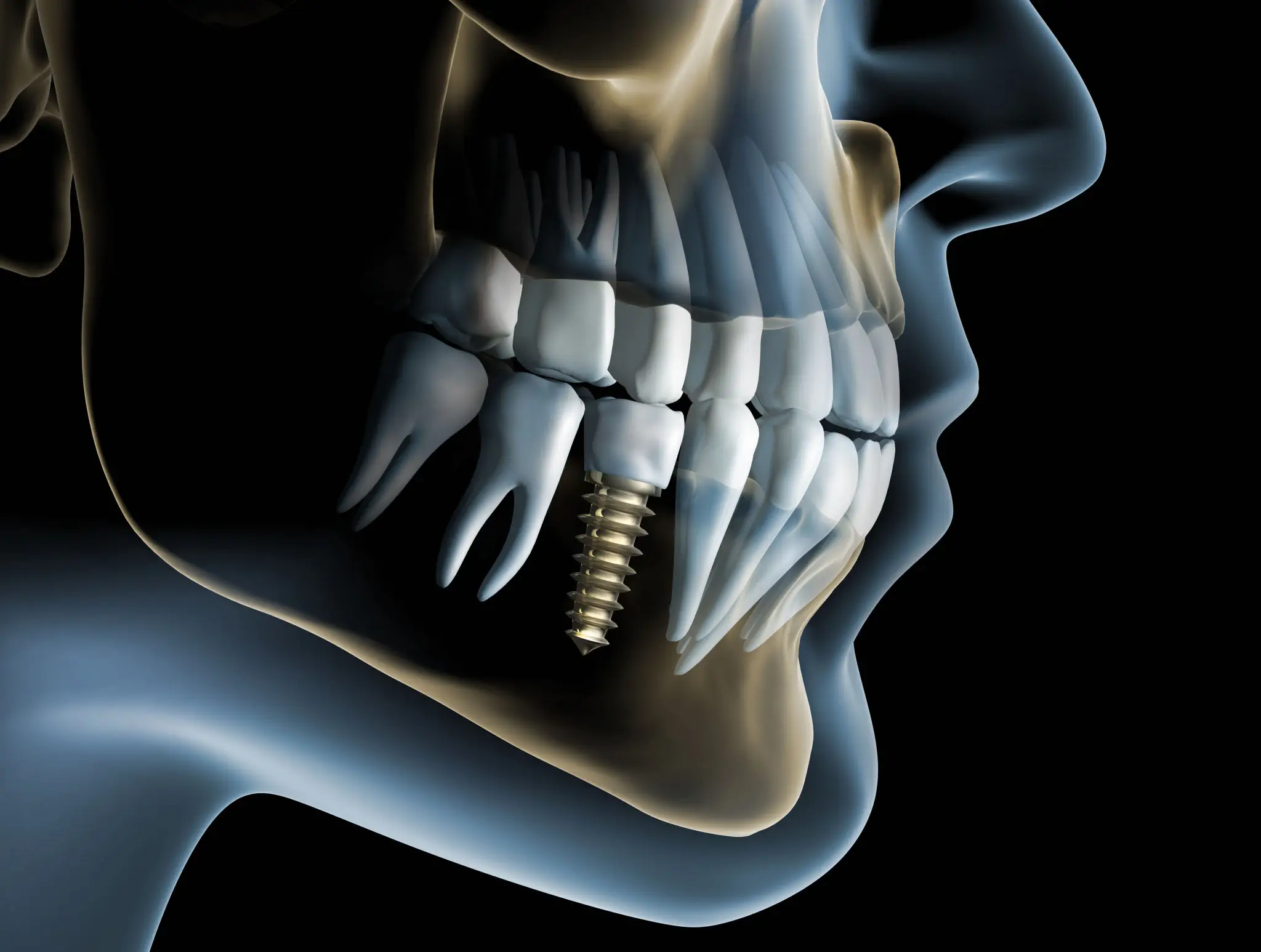 X-ray image showing a dental implant in the lower jaw.